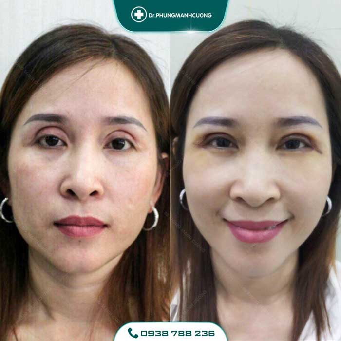 Chuyên Gia Sửa Mí Mắt Hỏng - Giải Cứu Thảm Họa Thẩm Mỹ 27 sua mat hong3 1