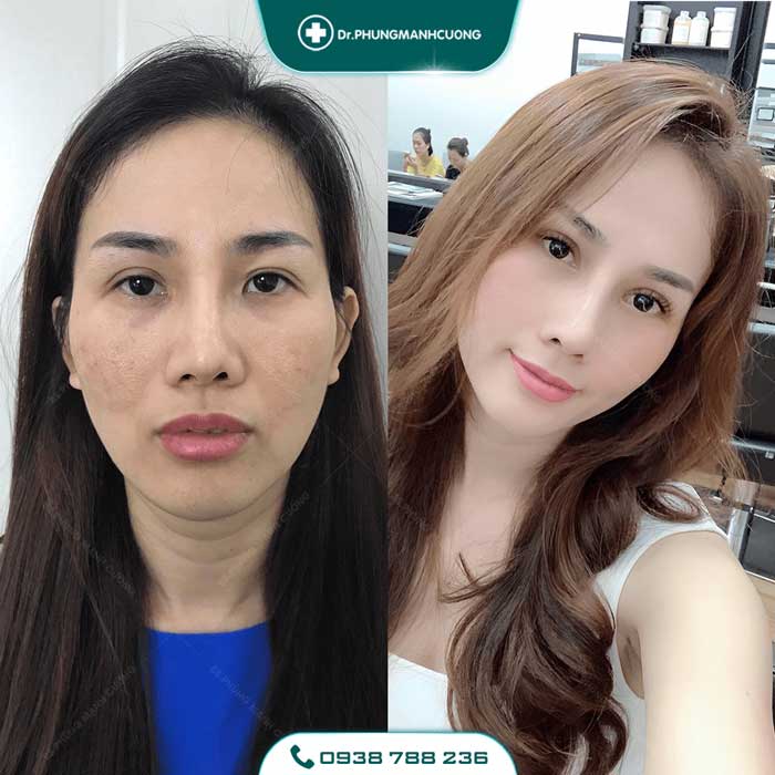 Chuyên Gia Sửa Mí Mắt Hỏng - Giải Cứu Thảm Họa Thẩm Mỹ 26 sua mat hong4 1