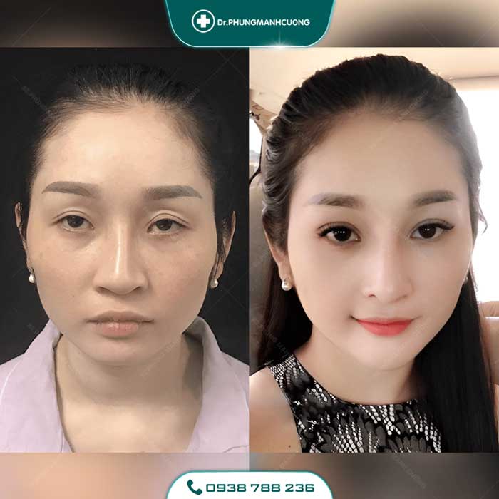 Chuyên Gia Sửa Mí Mắt Hỏng - Giải Cứu Thảm Họa Thẩm Mỹ 25 sua mat hong5 1