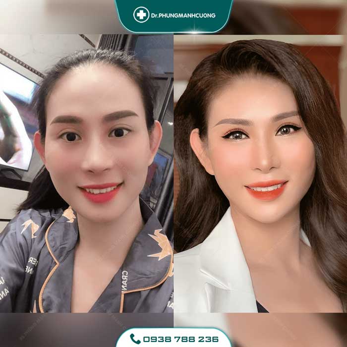 Chuyên Gia Sửa Mí Mắt Hỏng - Giải Cứu Thảm Họa Thẩm Mỹ 24 sua mat hong6 1