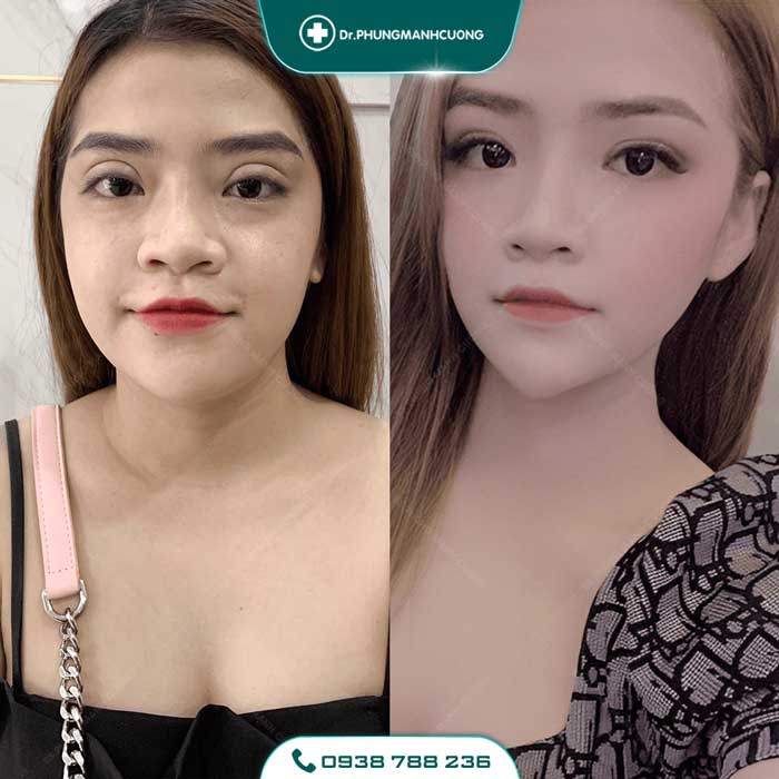 Chuyên Gia Sửa Mí Mắt Hỏng - Giải Cứu Thảm Họa Thẩm Mỹ 23 sua mat hong7 1