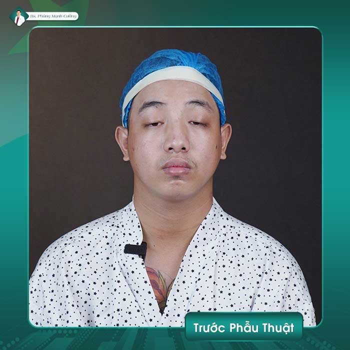 Có rất nhiều nguyên nhân dẫn đến sụp cơ nâng mi