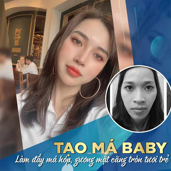 Tạo Hình Má (Baby) Mang Lại Khuôn Mặt Đầy Đặn Và Phúc Hậu 2021