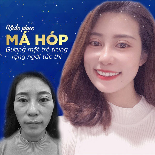 Tạo Hình Má (Baby) Khiến Khuôn Mặt Thêm Trẻ Trung