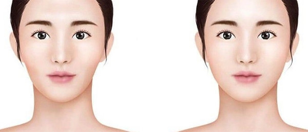 Tạo Hình Má (Baby) Tôn Tạo Khuôn Mặt Tươi Trẻ