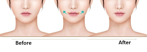 Tạo Khóe Môi Cười Làm Khuôn Mặt Luôn Tươi Tắn Rạng Ngời 21 Tạo Khóe Môi Cười Làm Khuôn Mặt Thêm Tươi Tắn