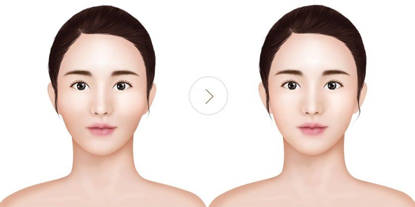 Thon Gọn Gò Má - Gương Mặt Thanh Tú Không Cần Phẫu Thuật