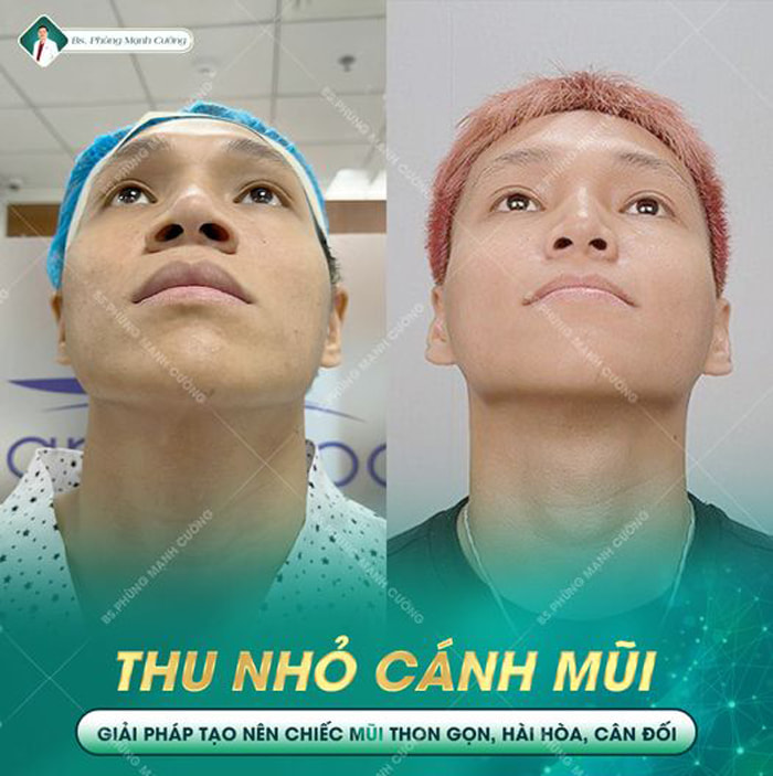 Thu Gọn Cánh Mũi Giải Pháp Khắc Phục Mũi To Bè Tốt Nhất