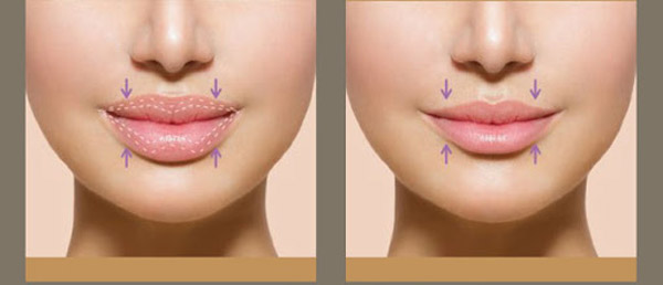 Thu Mỏng Môi - Thu Nhỏ Môi