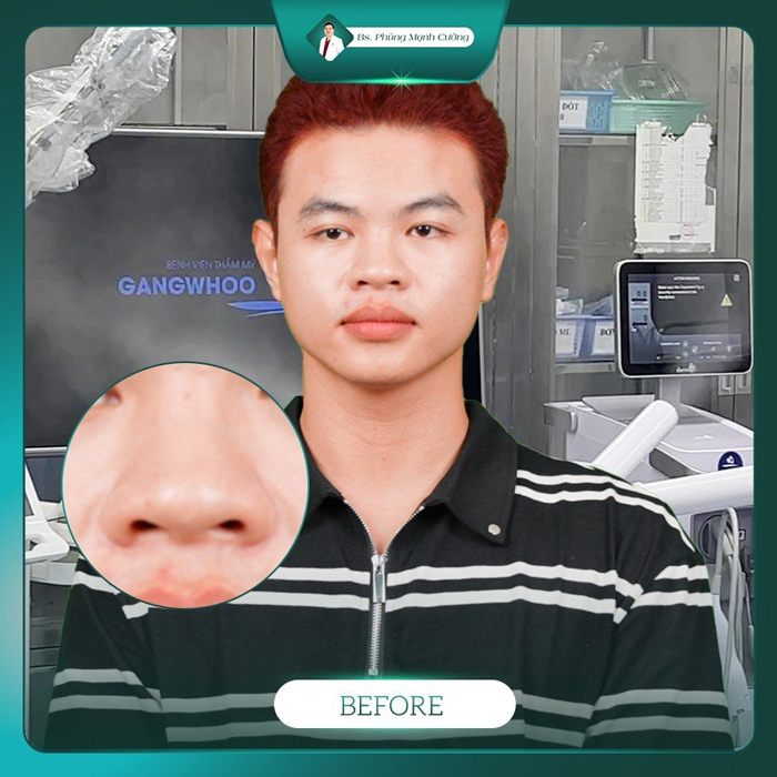 Thu nhỏ đầu mũi tại BS Cường có nhiều ưu điểm vượt trội