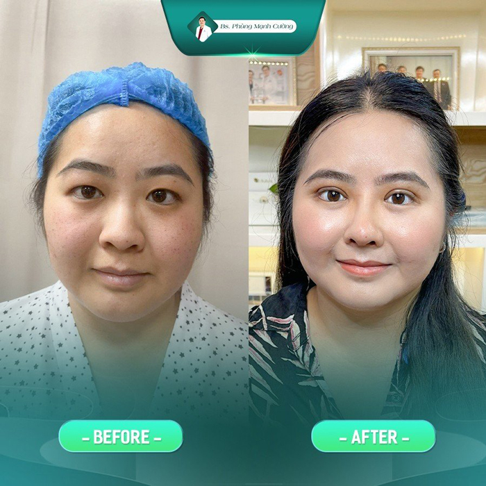 Đầu mũi được chỉnh gọn tự nhiên, cân đối và hài hòa với gương mặt