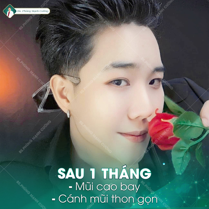 Thu Nhỏ Đầu Mũi Tạo Dáng Cân Xứng, Thon Gọn, Hài Hòa