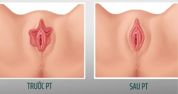 Thu Nhỏ Môi Bé Môi Lớn Cho Nàng Thêm Tự Tin