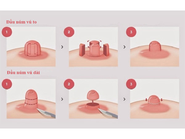 Thu Nhỏ Nhũ Hoa Giải Pháp Khắc Phục Cho Đầu Ti To Xấu Xí 14 Thu Nhỏ Nhũ Hoa Và Đầu Ti