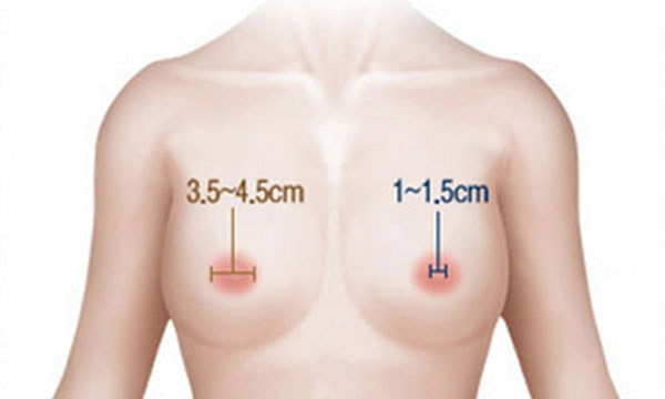 Thu Nhỏ Nhũ Hoa Giải Pháp Khắc Phục Cho Đầu Ti To Xấu Xí 16 Thu Nhỏ Nhũ Hoa, Núm Vú Hiệu Quả