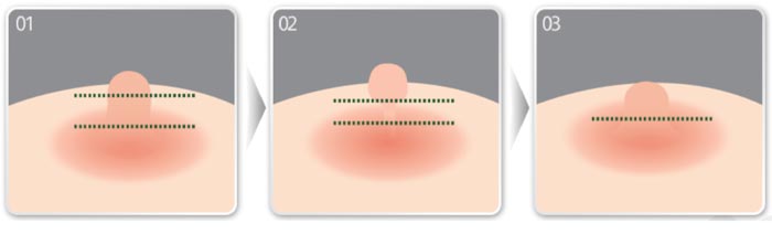 Thu Nhỏ Nhũ Hoa Giải Pháp Khắc Phục Cho Đầu Ti To Xấu Xí 18 thu nho nhu hoa 4 1