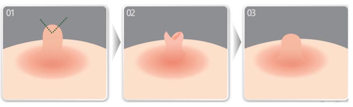 Thu Nhỏ Nhũ Hoa Giải Pháp Khắc Phục Cho Đầu Ti To Xấu Xí 19 thu nho nhu hoa 5 1