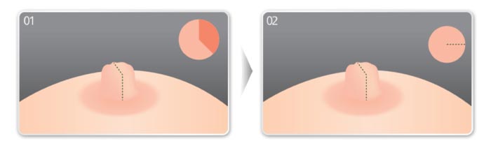 Thu Nhỏ Nhũ Hoa Giải Pháp Khắc Phục Cho Đầu Ti To Xấu Xí 20 Thu Nhỏ Nhũ Hoa Cho Đầu Ti Thêm Quyến Rũ