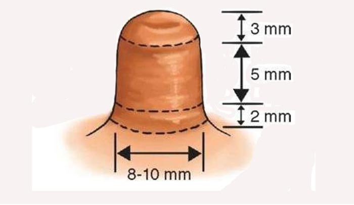 Thu Nhỏ Nhũ Hoa Giải Pháp Khắc Phục Cho Đầu Ti To Xấu Xí 13 thu nho nhu hoa 7