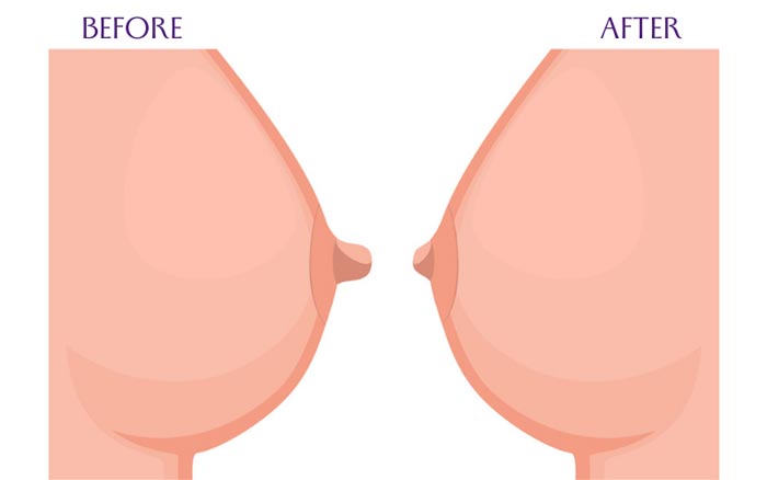 Thu Nhỏ Nhũ Hoa Giải Pháp Khắc Phục Cho Đầu Ti To Xấu Xí 21 thu nho nhu hoa 8