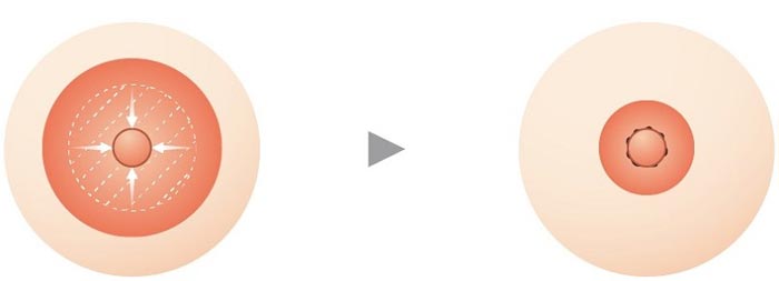 Thu Nhỏ Quầng Vú Giải Pháp "Đôi Gò" Trắng Hồng Đẹp Tự Nhiên