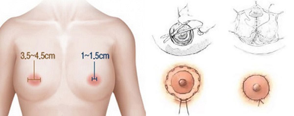 Thu Nhỏ Quầng Vú Để Ngực Đẹp Hơn