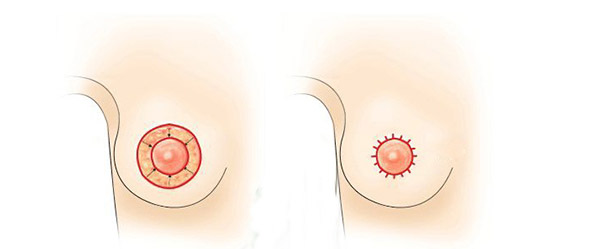 Nên Thu Nhỏ Quầng Vú Khi Quầng Ngực Quá To