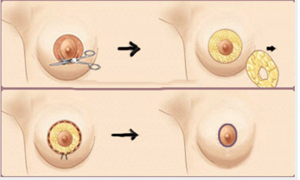 Thu Nhỏ Quầng Vú Là Phương Pháp Thẩm Mỹ Hiệu Quả