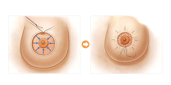 Thu Nhỏ Quầng Vú Để Xóa Bỏ Khuyết Điểm Quầng Ngực Phì Đại
