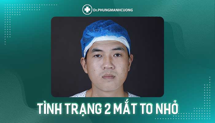 DẤU HIỆU NHẬN BIẾT MẮT TO MẮT NHỎ