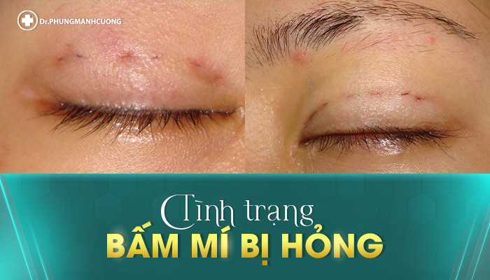 Chuyên Gia Sửa Mí Mắt Hỏng - Giải Cứu Thảm Họa Thẩm Mỹ 21 Tình trạng mắt bị sẹo