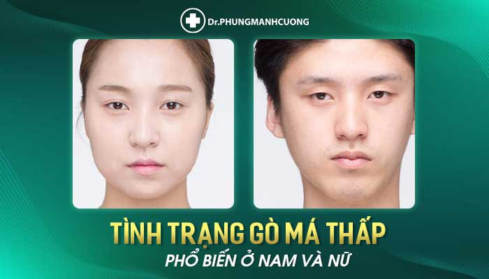 Phẫu Thuật Nâng Gò Má - Tôn Tạo Khuôn Mặt Hài Hòa Cân Đối 11 Tình trạng gò má thấp phổ biến đối với người Châu Á
