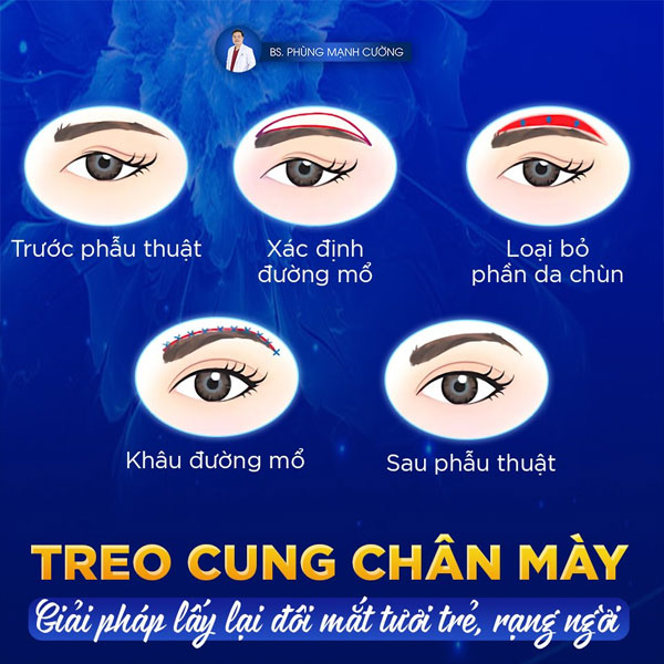 Nâng Cung Chân Mày Nội Soi - Treo Cung Chân Mày Cho Phái Đẹp