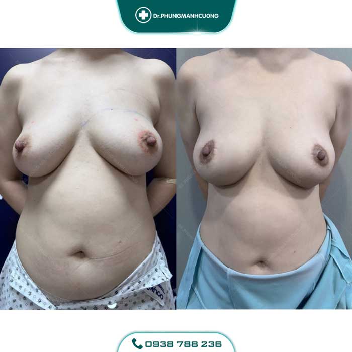 treo nguc sa tre 2 1