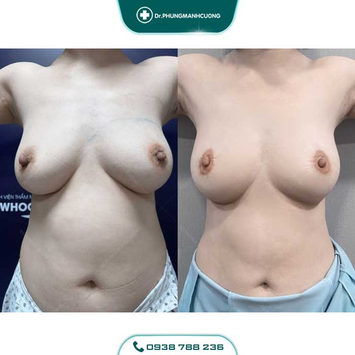 treo nguc sa tre 3 1