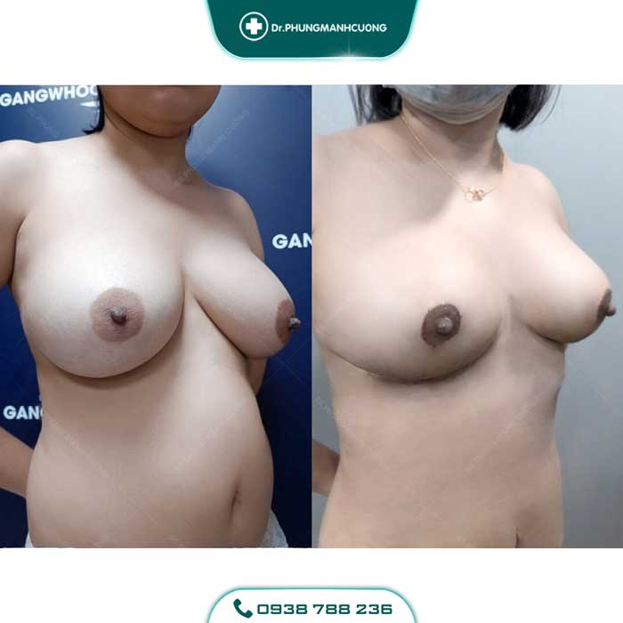 treo nguc sa tre 4 1