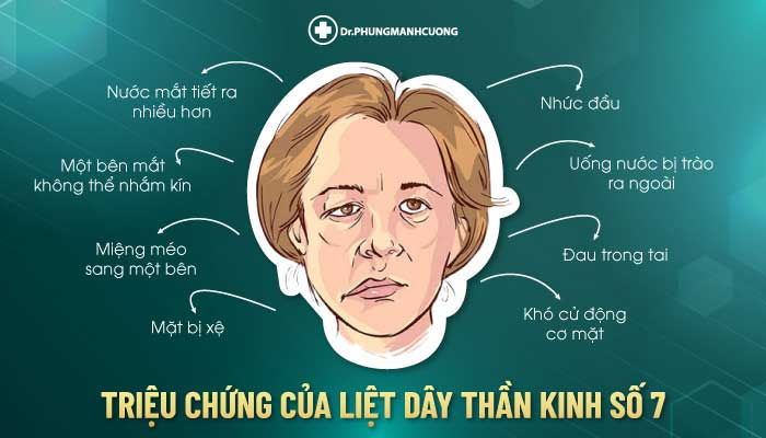 Điều Trị Liệt Mặt Ngoại Biên An Toàn, Hiệu Quả 100% 26 Các triệu chứng của liệt dây thần kinh số 7