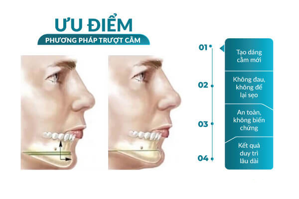Ưu Điểm Phẫu Thuật Trượt Gọt Cằm