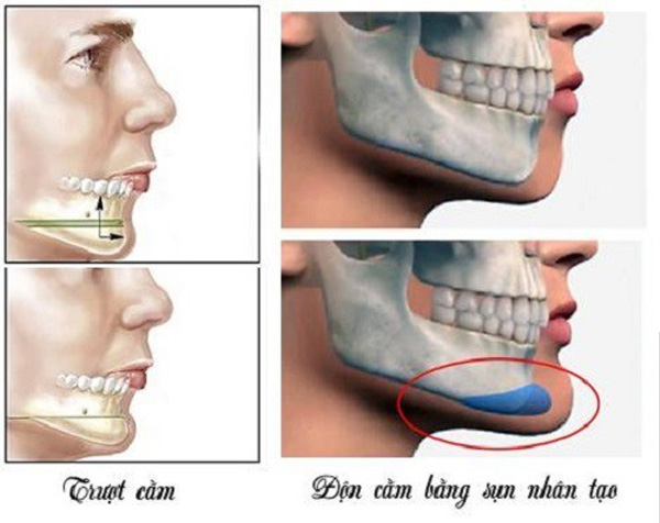 Sự khác biệt giữa trượt cằm và gọt hàm