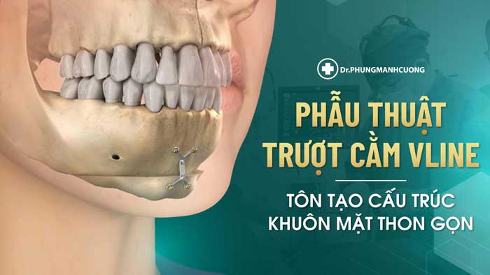 Trượt cằm tại BS Phùng Mạnh Cường an toàn chuẩn Y Khoa