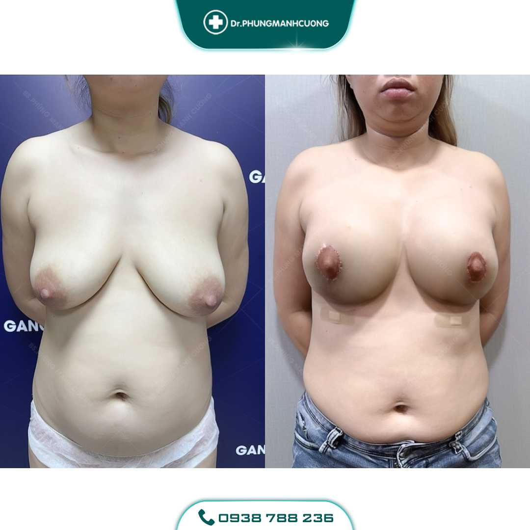 Thu Nhỏ Vú Phì Đại Giải Pháp Khắc Phục Bầu Ngực Sập Xệ 19 ts 4