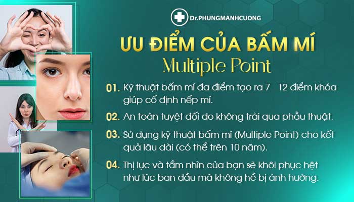 Những ưu điểm nổi bật của bấm mí Multiple Point tại BS Phùng Mạnh Cường