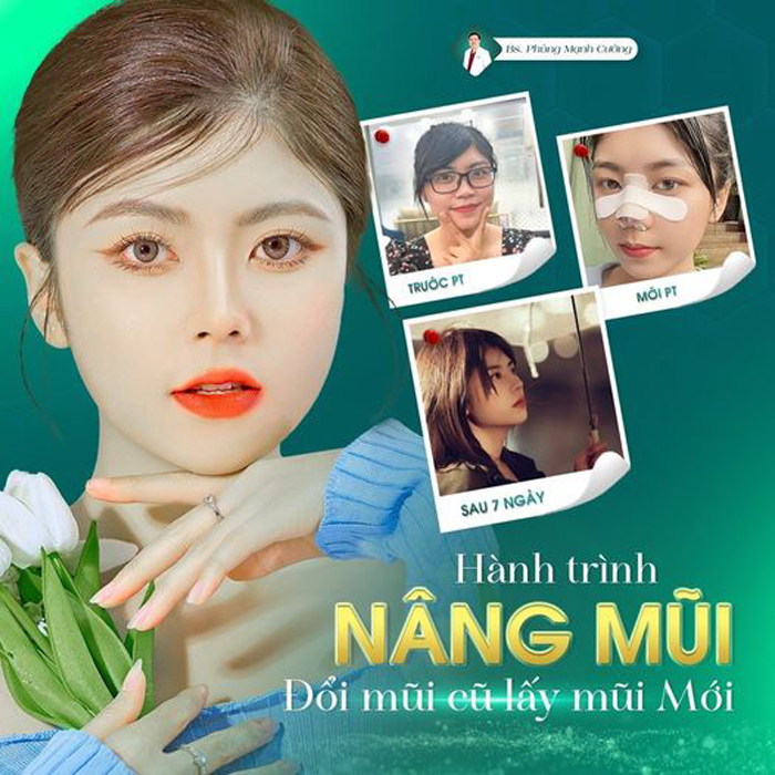 Chỉnh Dị Tật Mũi - Giải Pháp "Cứu Cánh" Cho Mũi Biến Dạng 12 Ưu điểm chỉnh sửa mũi dị tật tại bác sĩ Phùng Mạnh Cường