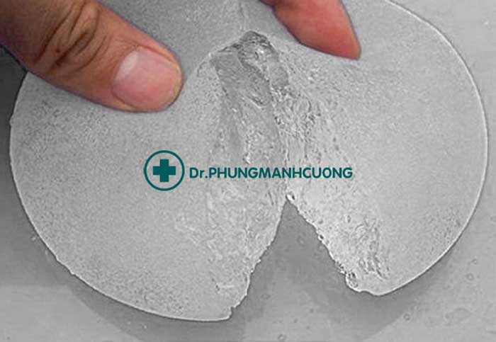 Ngực sau nâng bị rò rỉ hay bị nổ túi độn