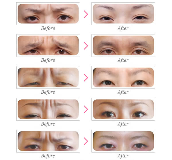 Xóa Cơ Cau Mày Không Cần Phẫu Thuật