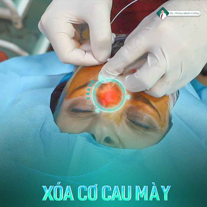 xoa co cau may 3 1