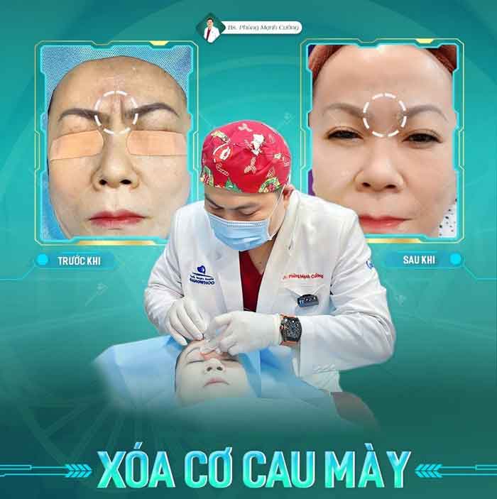 xoa co cau may 3