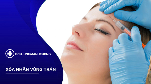 Xóa Nhăn Cơ Trán Hiệu Quả Và An Toàn